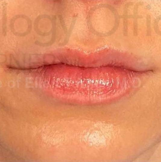 Juvederm (1 Syringe) Case-11 After