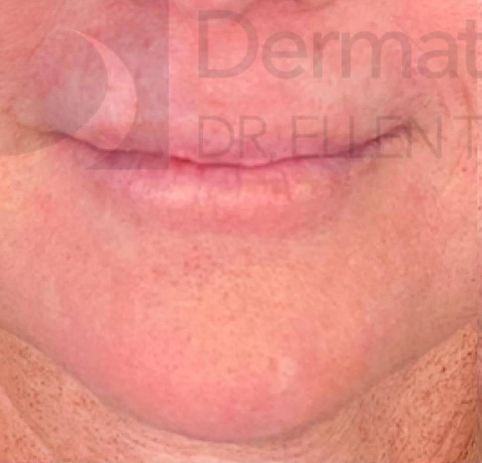 Juvederm (1 Syringe) Case-12 Before