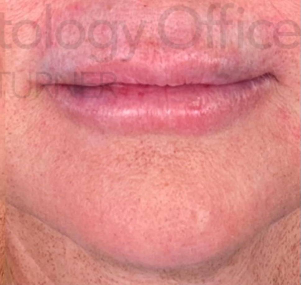 Juvederm (1 Syringe) Case-12 After