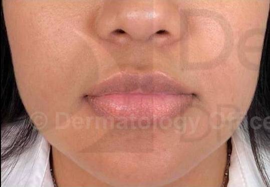 Juvederm (1 Syringe) Case-13 Before