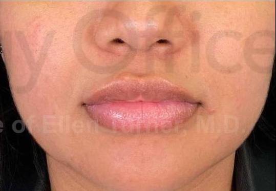Juvederm (1 Syringe) Case-13 After