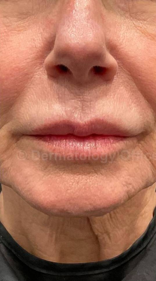 Juvederm (1 Syringe) Case-17 Before
