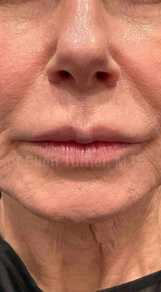Juvederm (1 Syringe) Case-17 After