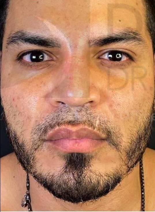 Facial Contouring with Fillers (20U Botox, 3RHA4, 2 Voluma) Case 1 Before