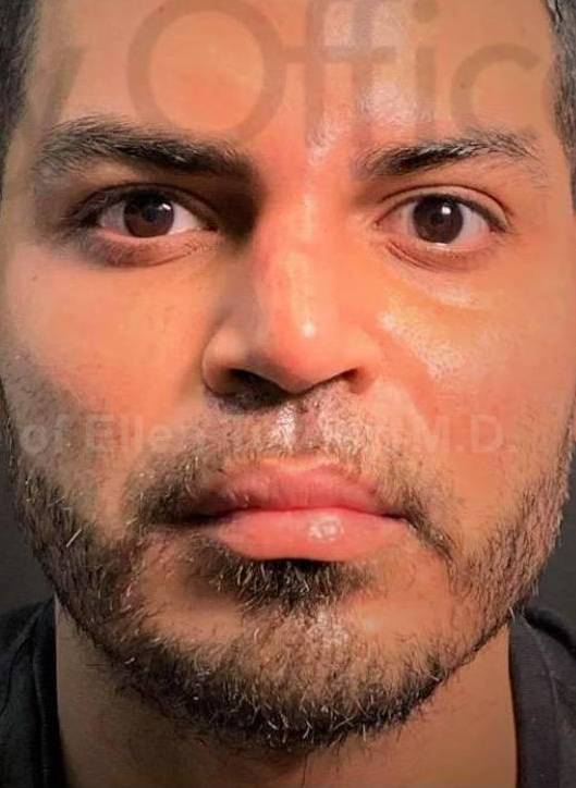 Facial Contouring with Fillers (20U Botox, 3RHA4, 2 Voluma) Case 1 After