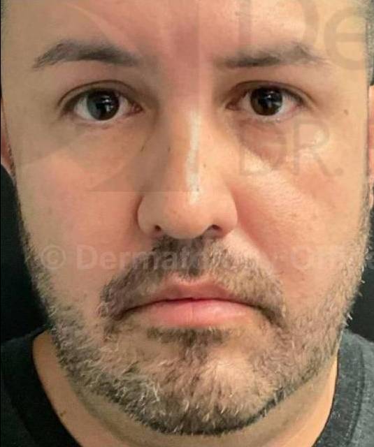 Facial Contouring with Filler (4 Voluma, 1 Kybella) Case 2 Before