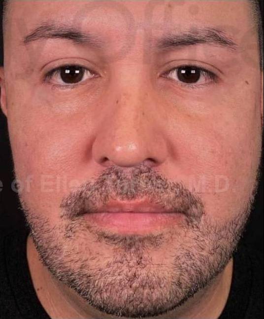 Facial Contouring with Filler (4 Voluma, 1 Kybella) Case 2 After