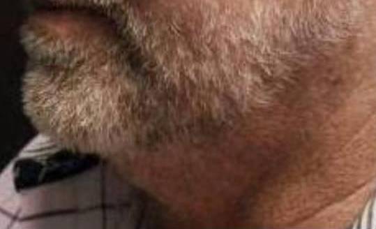 Facial Contouring with Filler (4 Voluma) Case-3 Before