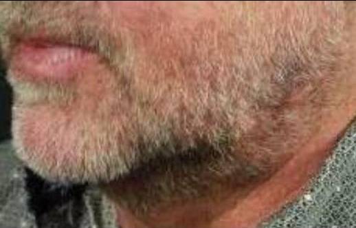 Facial Contouring with Filler (4 Voluma) Case-3 After