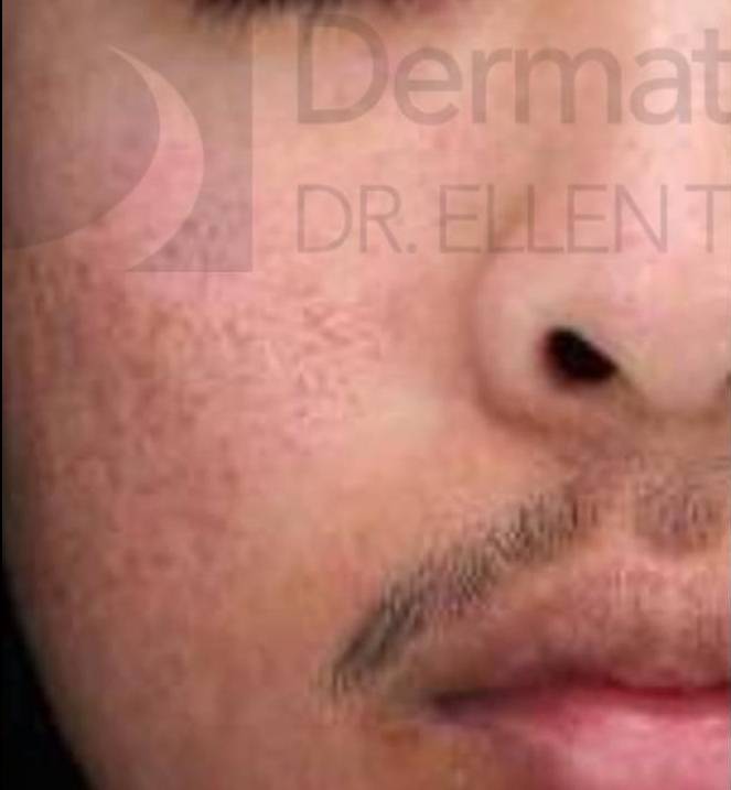 Halo (2 Treatment) Case-4 Before