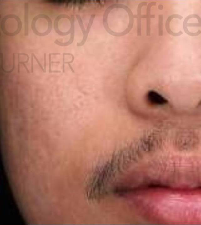 Halo (2 Treatment) Case-4 After