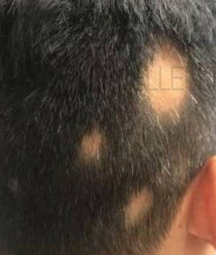 Hair Loss (2 Treatments ExoFlo) Case-5 Before