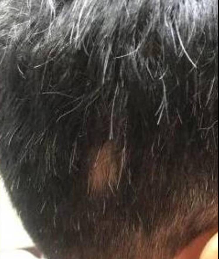 Hair Loss (2 Treatments ExoFlo) Case-5 After
