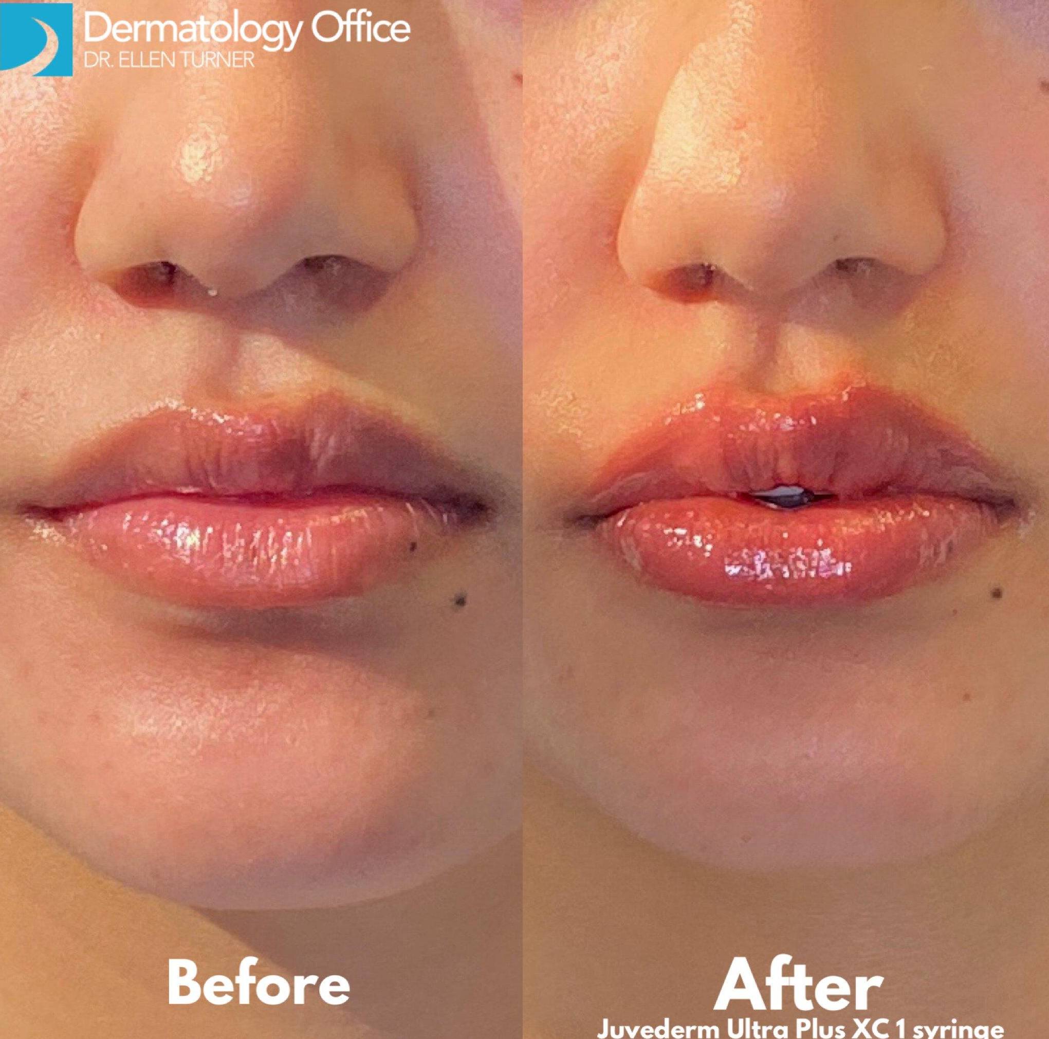 Juvederm (2 Syringes) Case-5 