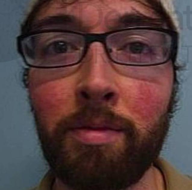 Rosacea (2 Treatment BBL) Case-7 Before