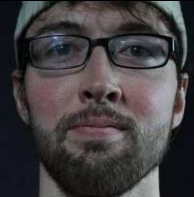 Rosacea (2 Treatment BBL) Case-7 After