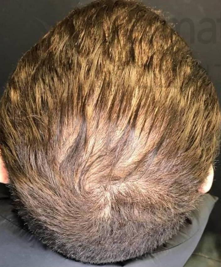 Platelet-Rich Plasma (3 Treatment) Case-9 Before