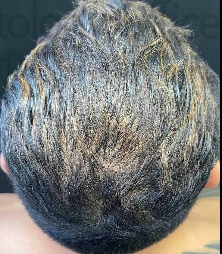 Platelet-Rich Plasma (3 Treatment) Case-9 After