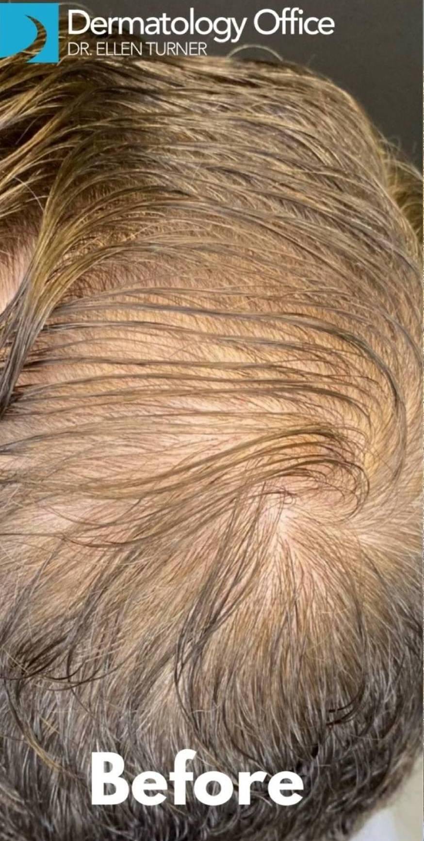 Hair Loss Before and After 10 Before