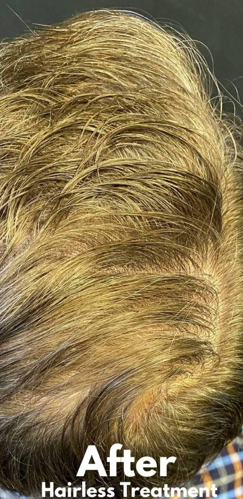 Hair Loss Before and After 10 After