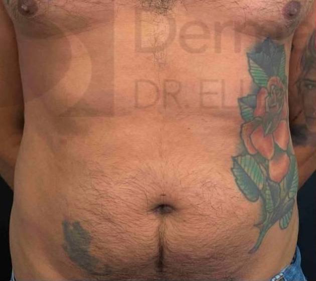 Radiesse Before And After 13 Before