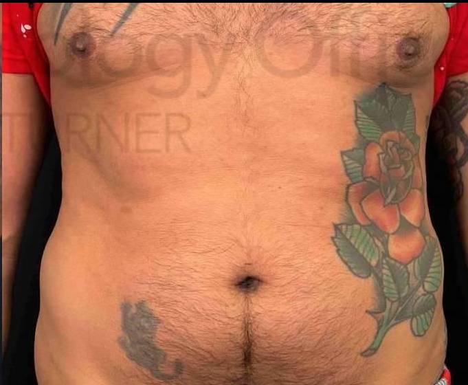 Radiesse Before And After 13 After