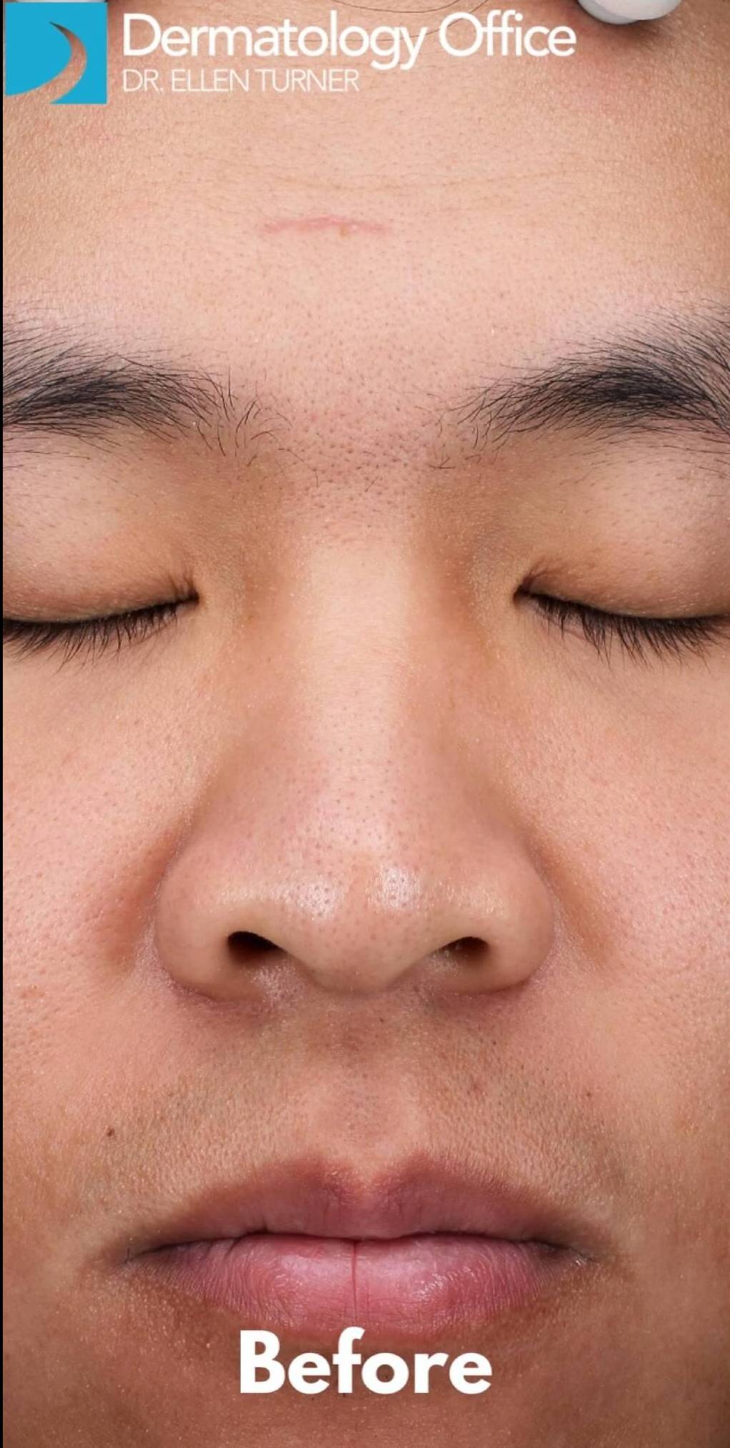 Halo Before and After 23 Before