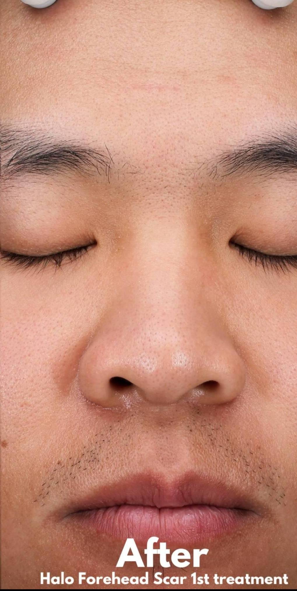 Halo Before and After 23 After