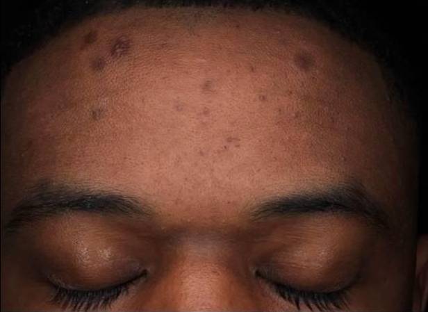 Halo Before and After 24 Before