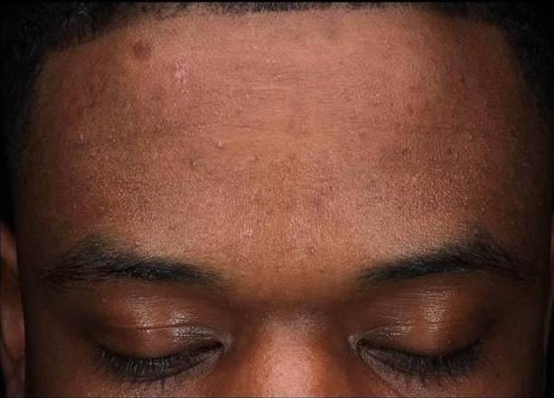 Halo Before and After 24 After