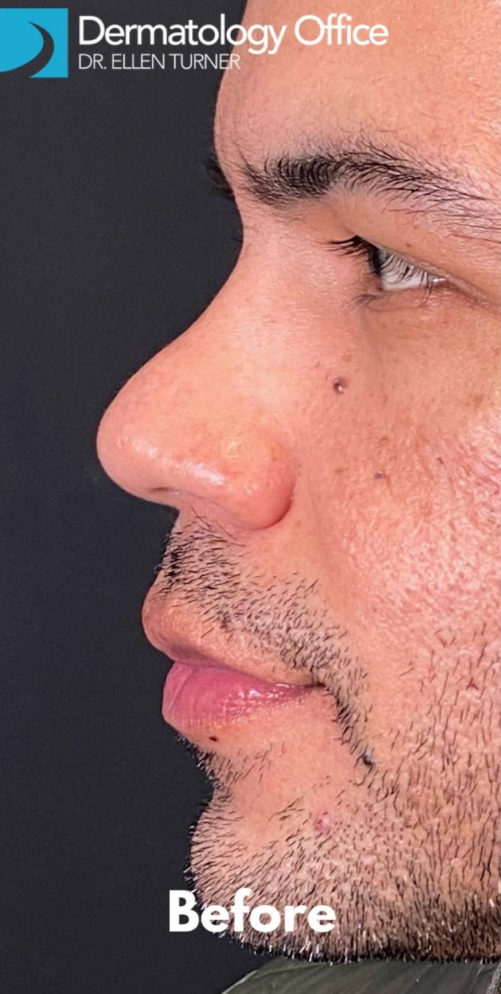 Facial Contouring and Filler for Men 25 Before