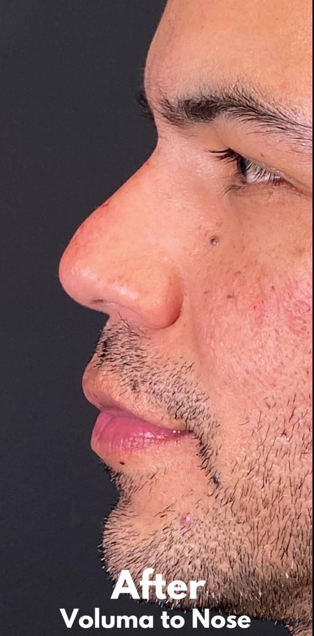 Facial Contouring and Filler for Men 25 After