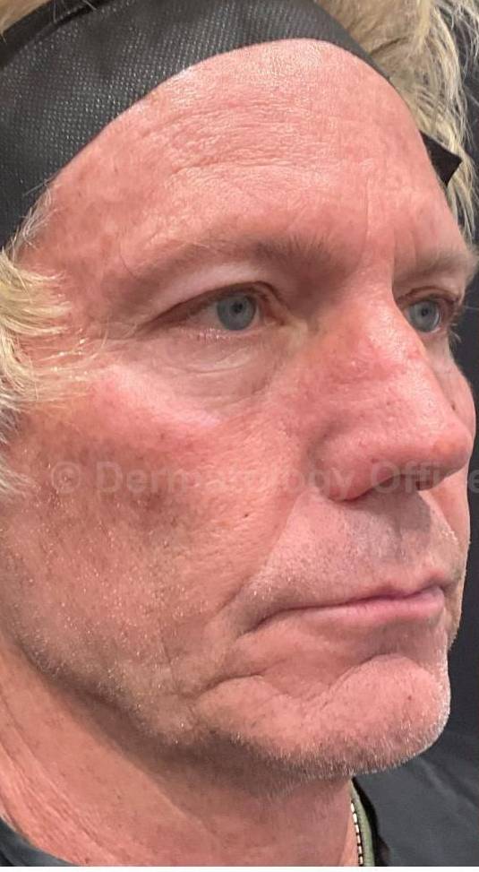 Restylane Before and After Case 27 Before