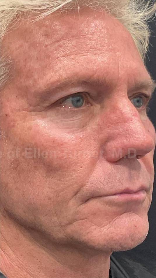 Restylane Before and After Case 27 After