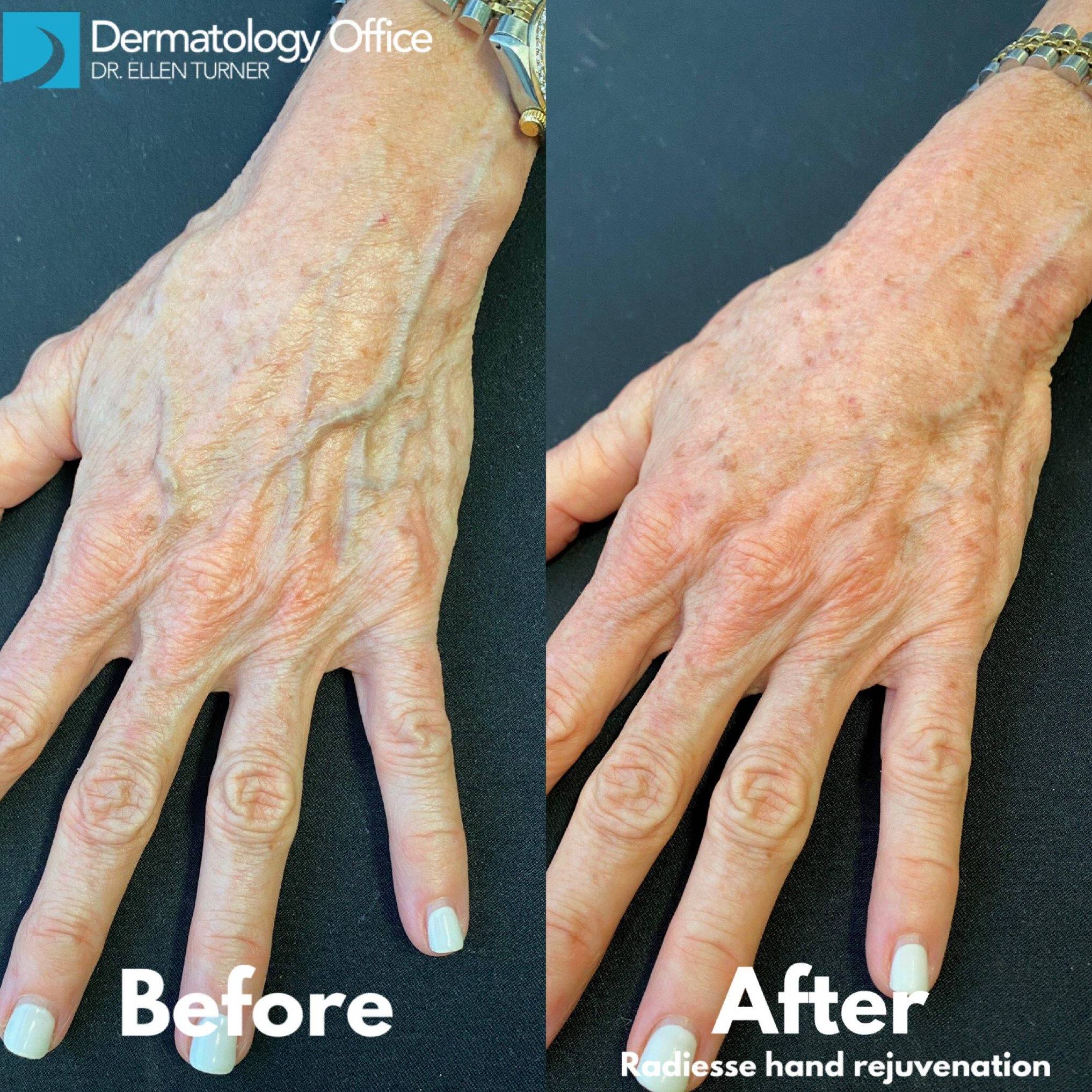 Radiesse Hands (2 Syringes) Before and After Case 8 