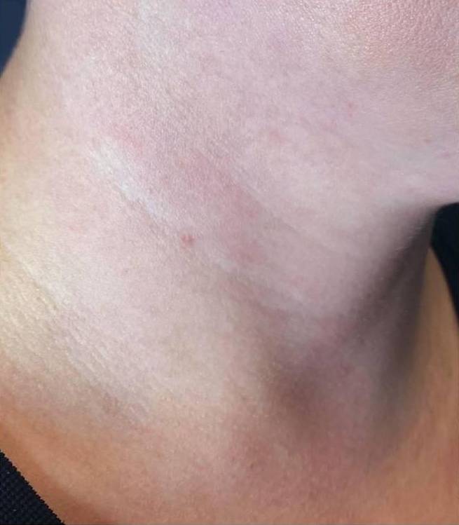 Restylane Before and After Case 3 Before