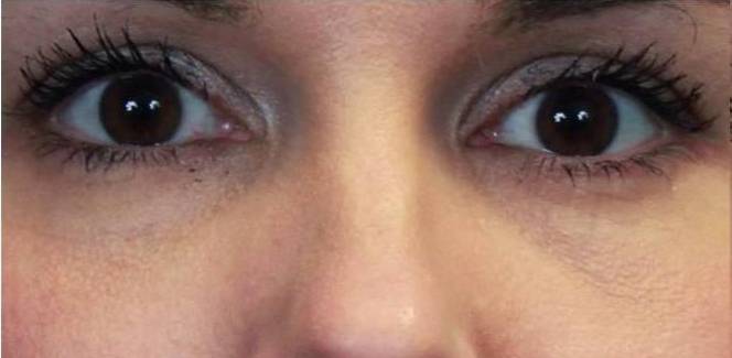 Restylane Before and After Case 2 Before