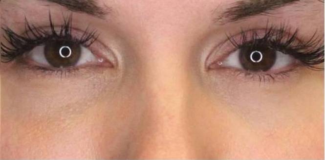 Restylane Before and After Case 2 After