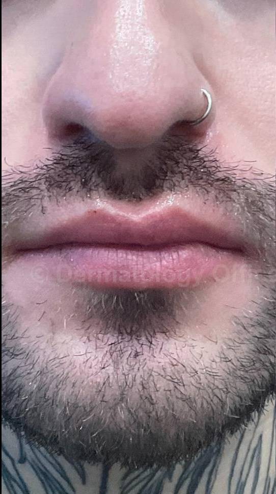 Restylane Before and After Case 23 Before