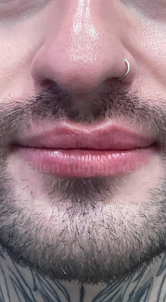 Restylane Before and After Case 23 After