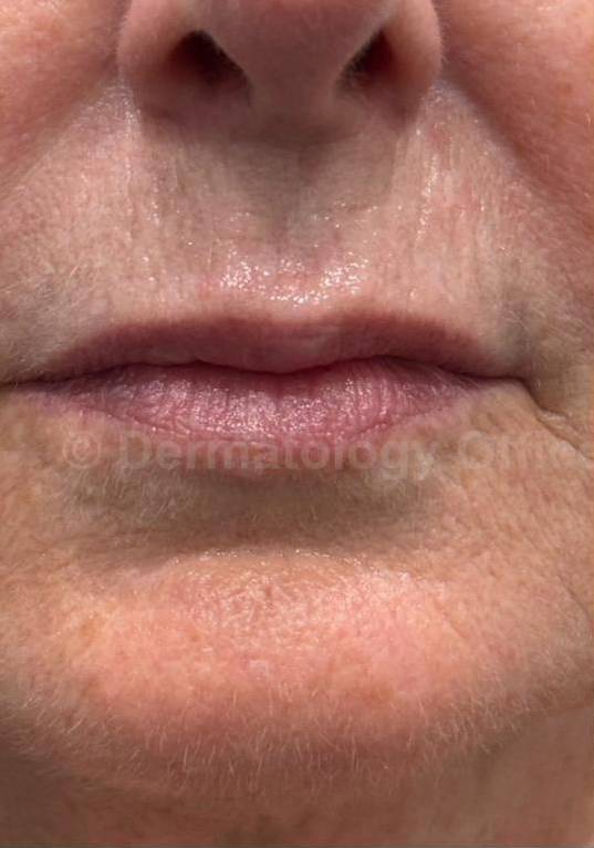 Restylane Before and After Case 22 Before