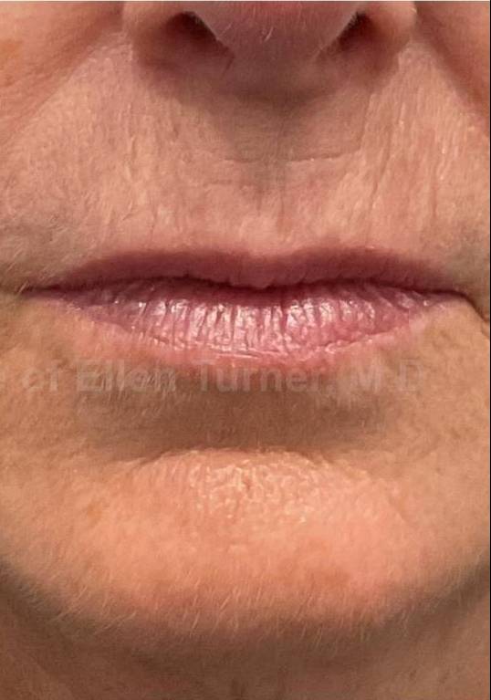 Restylane Before and After Case 22 After