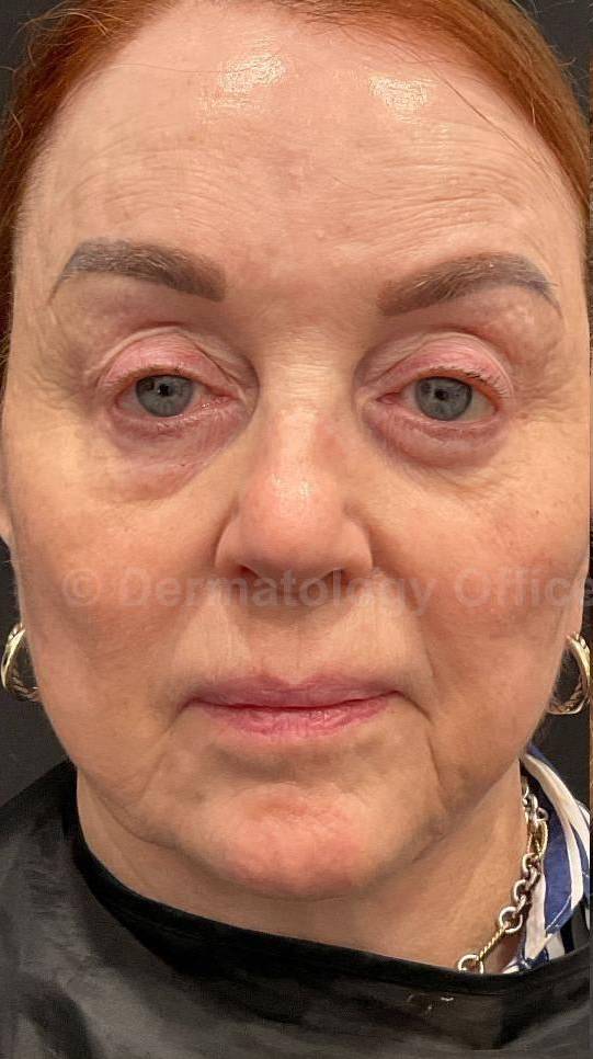 Restylane Before and After Case 21 Before