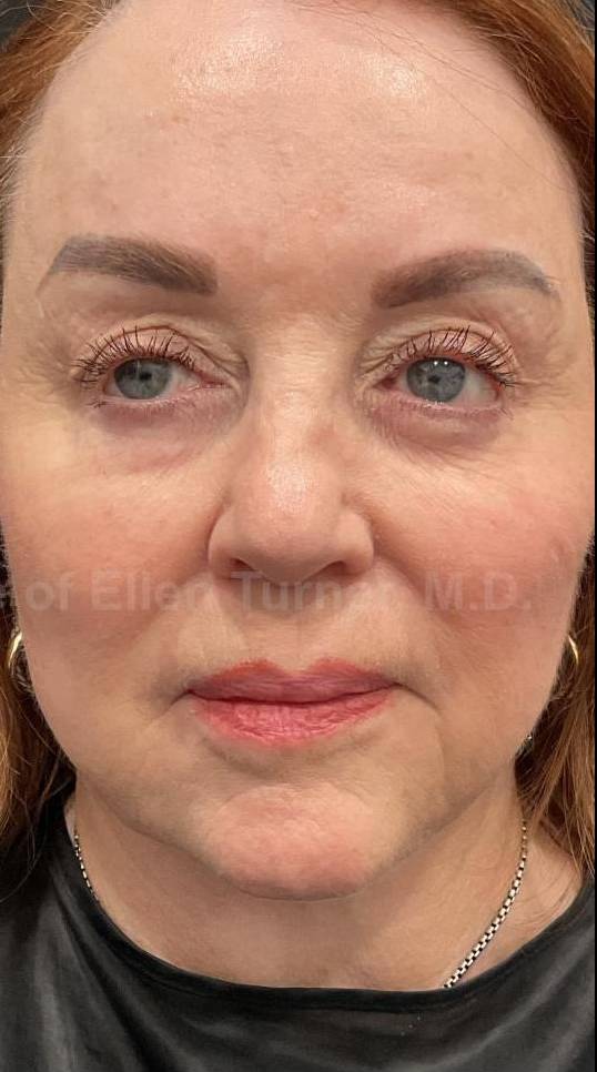 Restylane Before and After Case 21 After