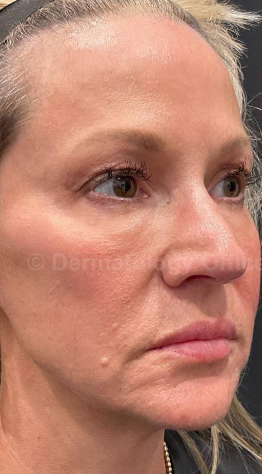 Restylane Before and After Case - 20 Before