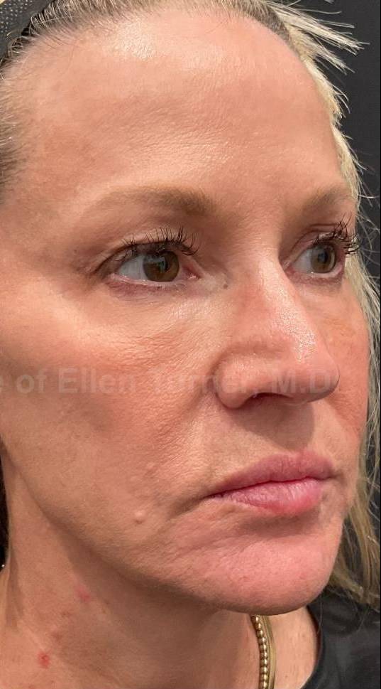 Restylane Before and After Case - 20 After