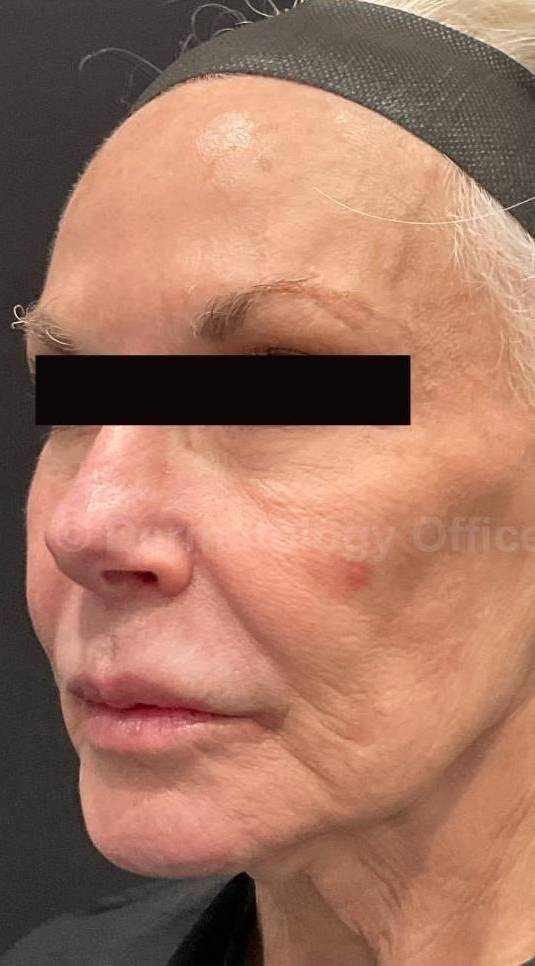 Restylane Before and After Case 19 Before