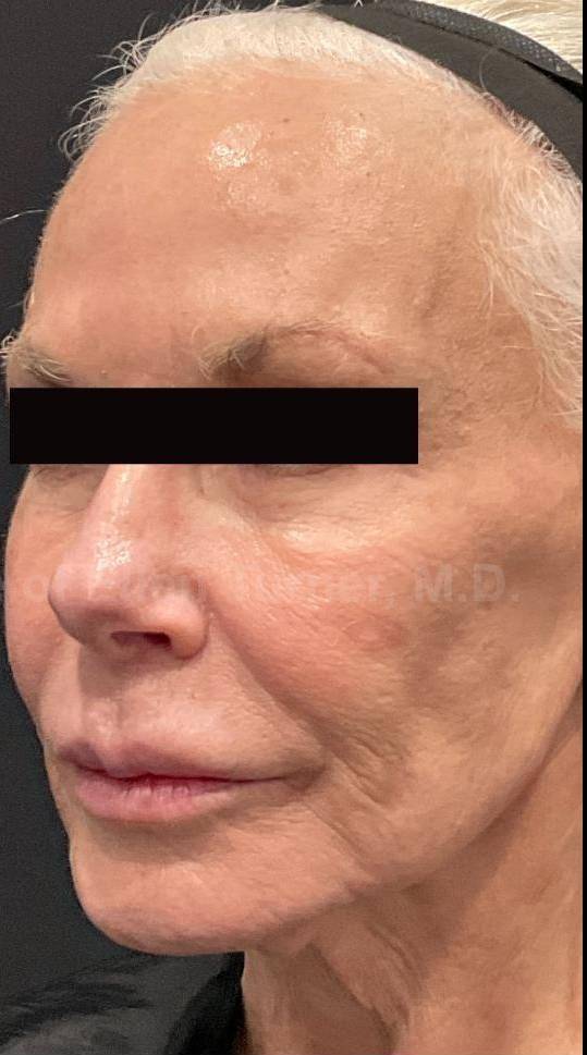 Restylane Before and After Case 19 After