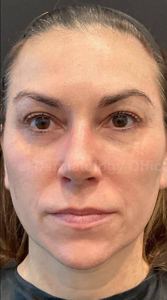 Restylane Before and After Case 18 Before