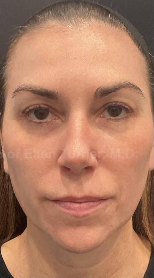 Restylane Before and After Case 18 After